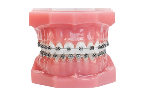 clasic braces in dental clinic