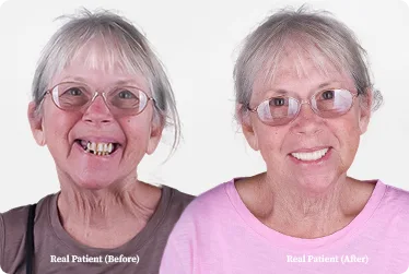 3 on 6 dental implants photo