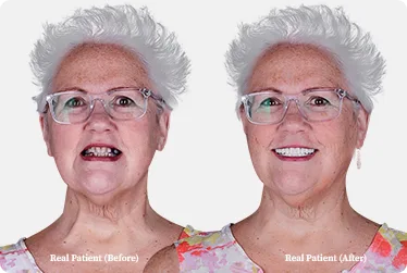 3 on 6 dental implants photo