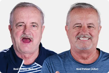 3 on 6 dental implants photo