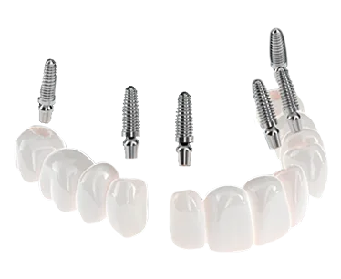 3 on 6 dental implants model