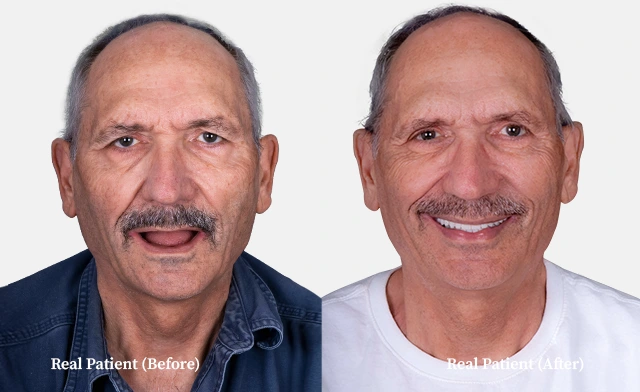 patient dental crowns before and after