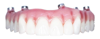 upper all on 4 hybrid denture