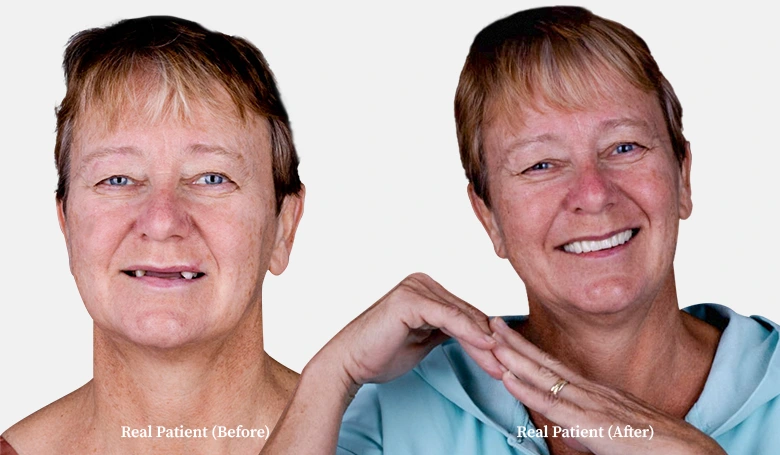 patient all on 4 dental implants before and after