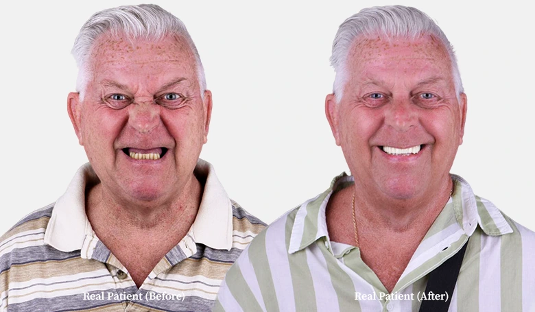 patient all on 4 dental implants before and after