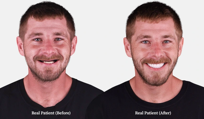 patient all on 4 dental implants before and after