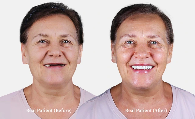 patient all on 4 dental implants before and after