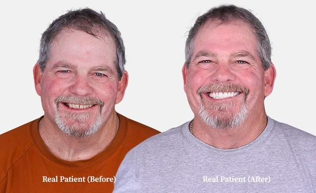 patient all on 4 dental implants before and after