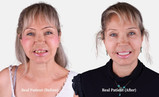 patient all on 4 dental implants before and after