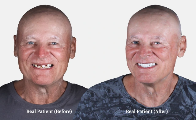 patient all on 4 dental implants before and after