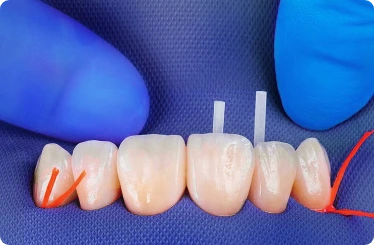 root canal procedure for a crown