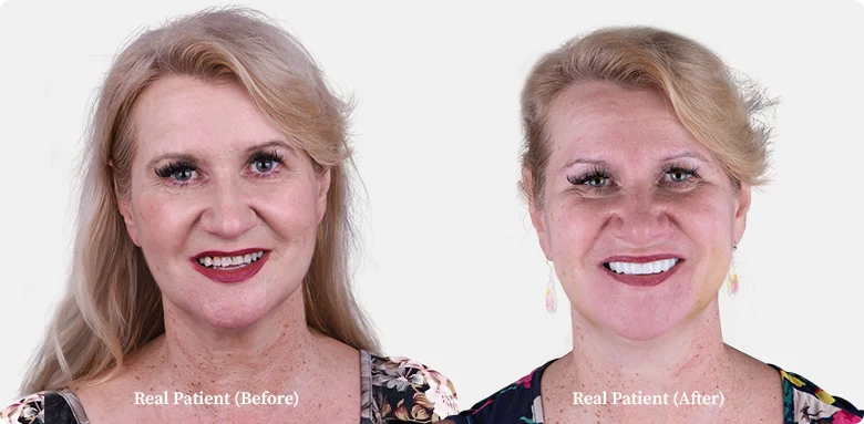 3 on 6 dental implants photo