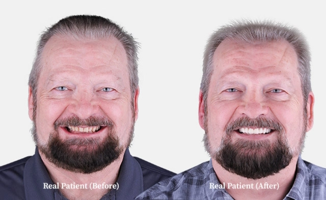 patient dental crowns before and after