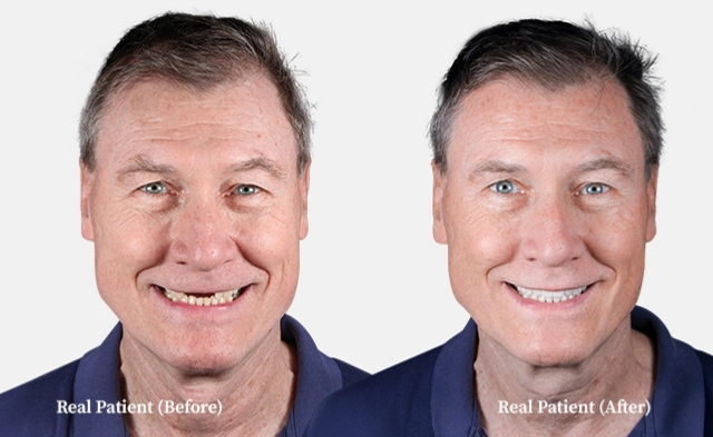 patient dental crowns before and after