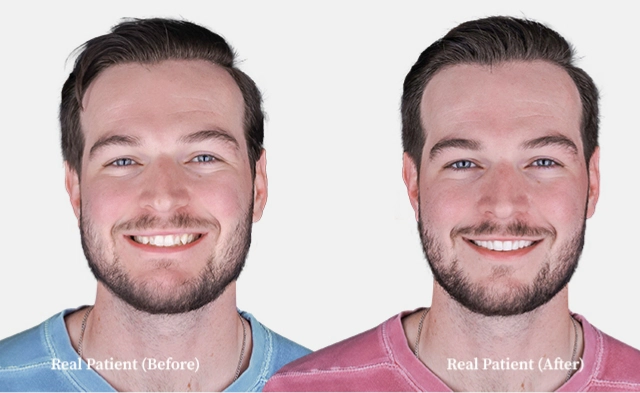 Dr. Hoffmann patient before and after veneers treatment