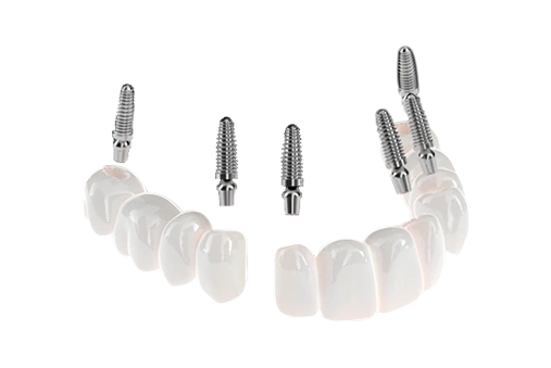 photo of 3 on 6 dental implants