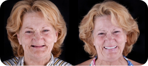 before and after her all on 4 dental implants treatment