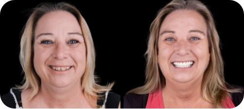 Before and After Dental Crowns in Smile Crafters