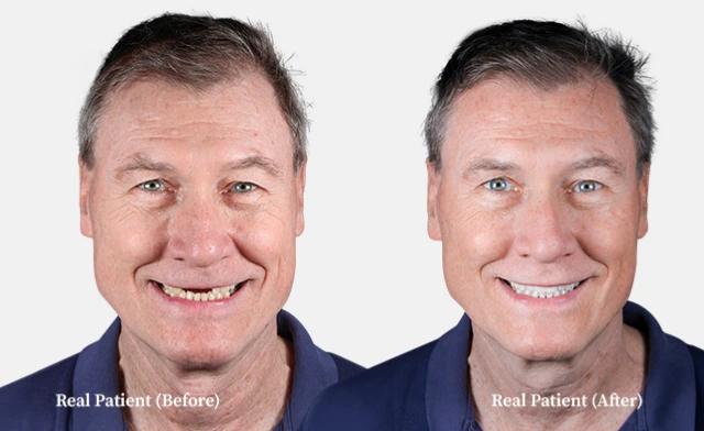 patient all on 4 dental implants before and after 01