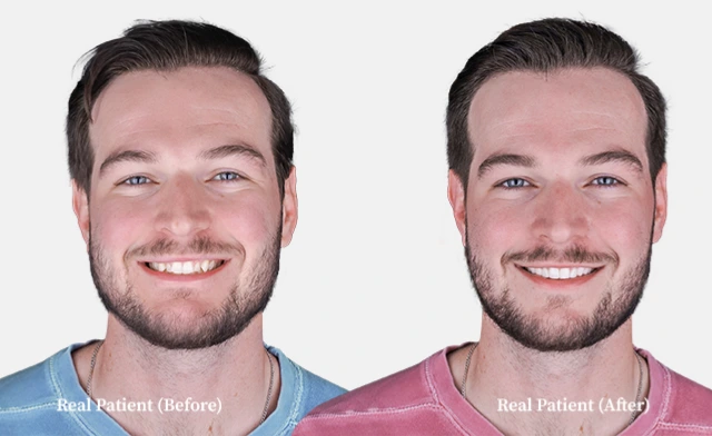 patient all on 4 dental implants before and after 03