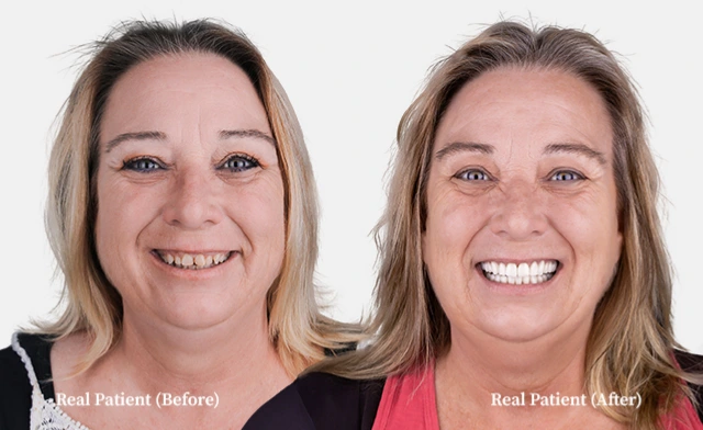 patient all on 4 dental implants before and after 04