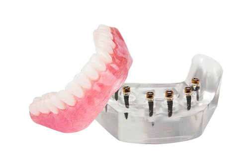 snap on dentures 6 regular implants algodones mexico