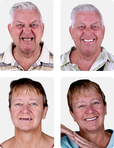 Los Algodones all on 4 dental implants before and after pictures from patients