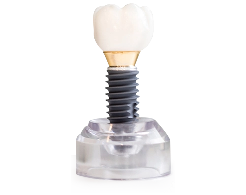 dental implant and a porcelain crown