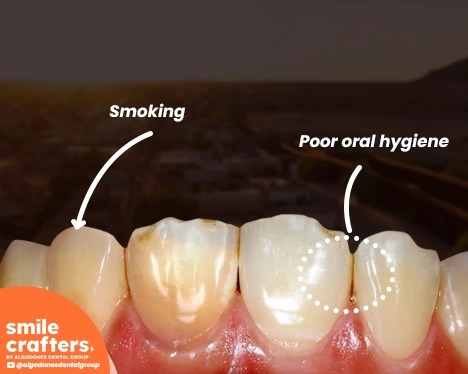 What causes yellow teeth and How to get rid of them?