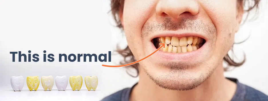 Before and after image showing transformation from yellow teeth to a bright white smile.