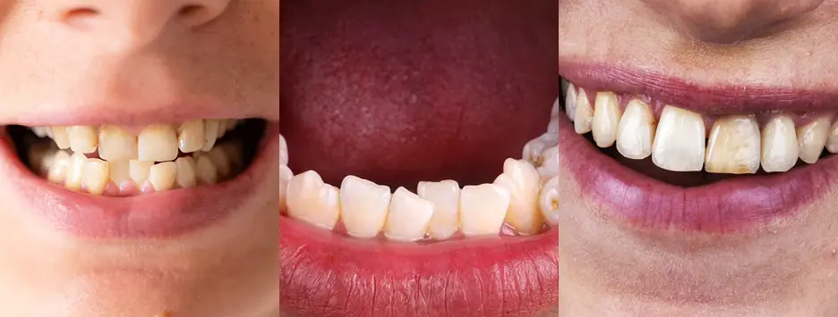 lose-up of stained teeth highlighting that poor oral health is more than just a cosmetic issue.