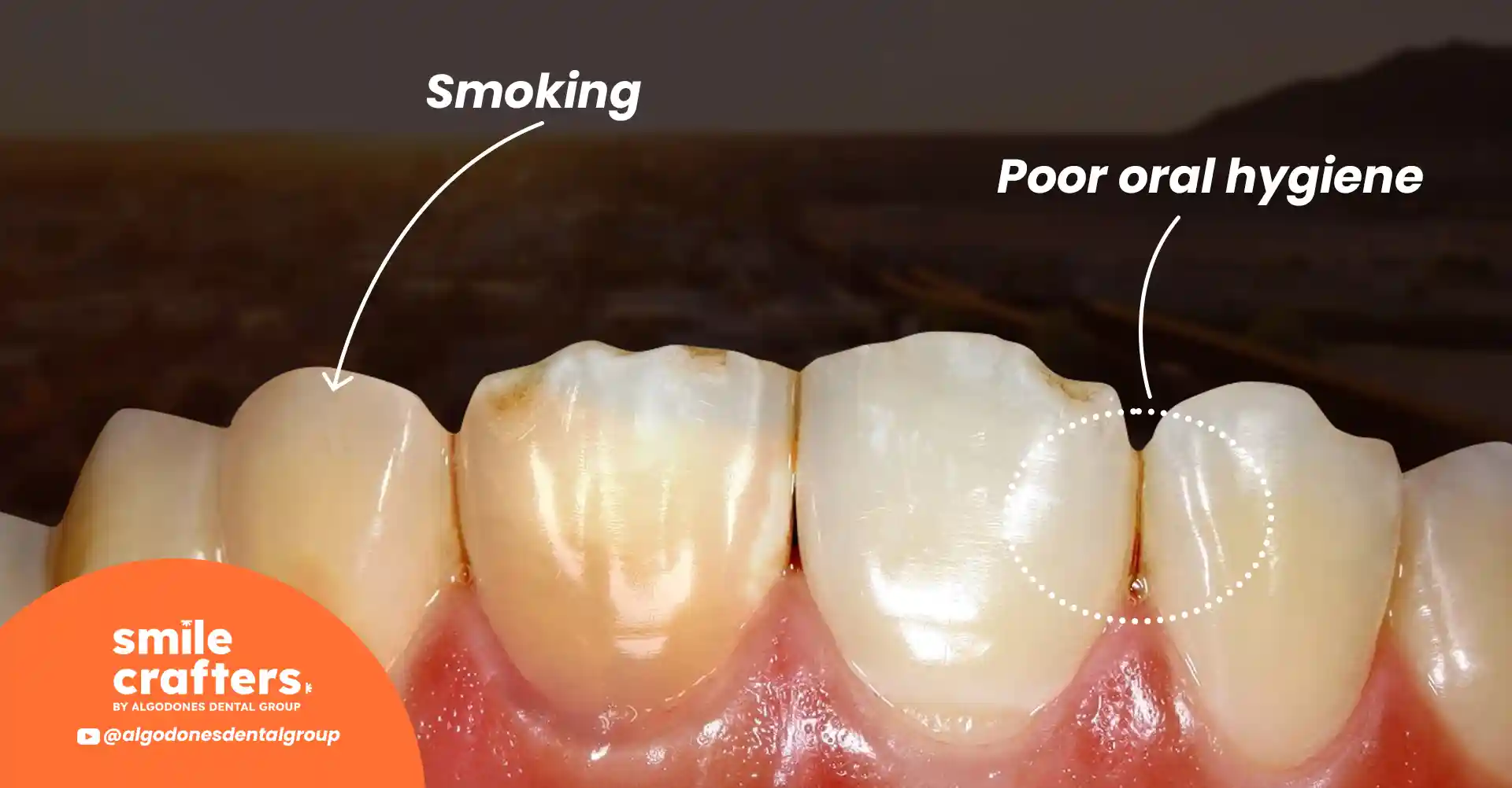 representing the causes of yellow teeth and how to get rid of them