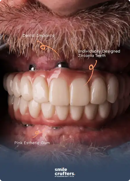 dental implants algodones