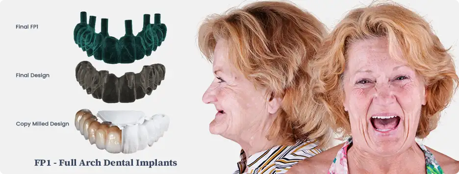 FP1 full arch dental implants