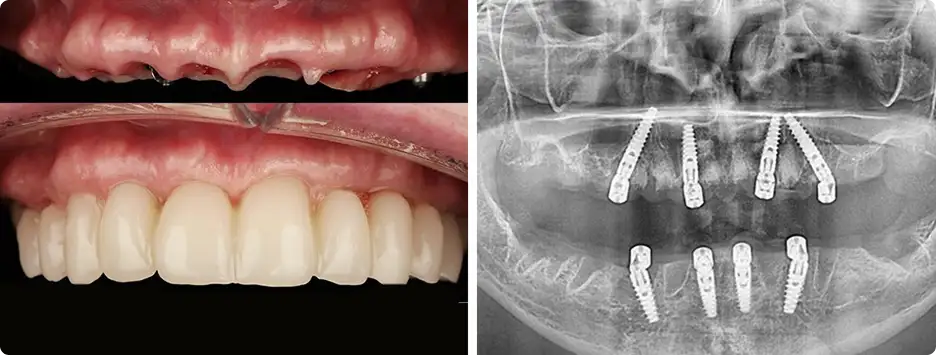 x ray FP1 dental implants
