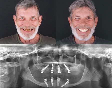 mandibular-bone-requeriments