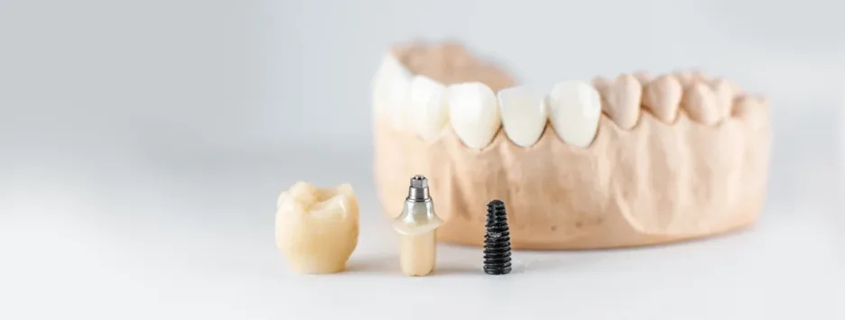 Visual explanation of the origin and evolution of dental implants, including zirconium options