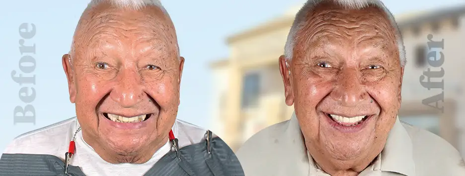 Before and after comparison of a patient's smile transformation with veneers and crowns at a Los Algodones dental clinic.